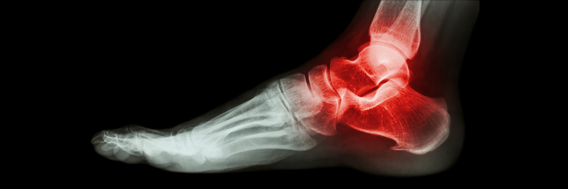 laser therapy for heel spurs
