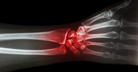 Laser Therapy and magnetotherapy for carpal tunnel syndrome