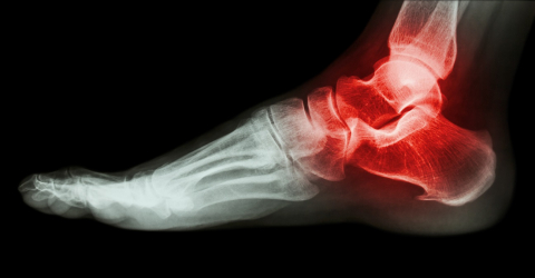 Hilterapia calcaneal spur treatment